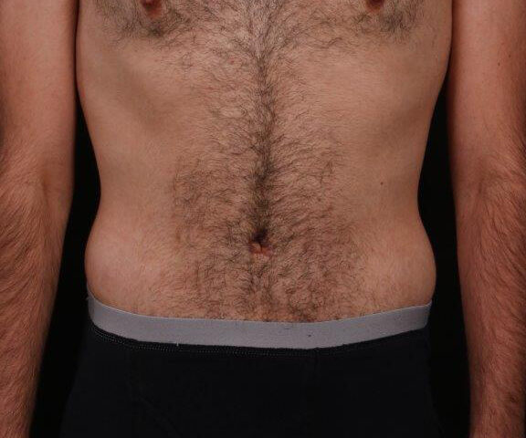 After Image: Tummy Tuck - front