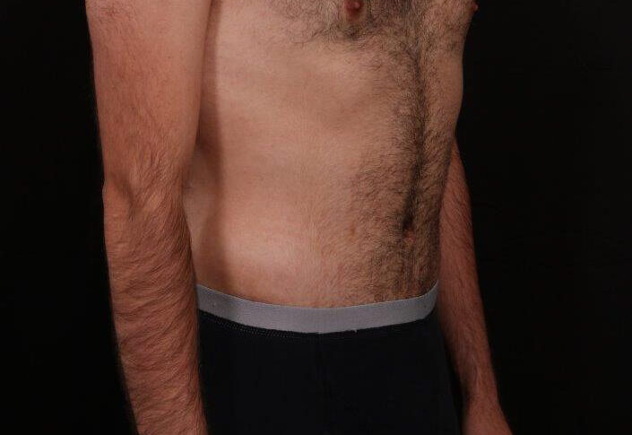 After Image: Tummy Tuck - right-front-oblique