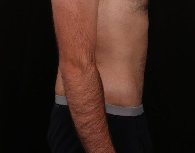 After Image: Tummy Tuck - right-side