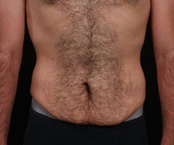 Before Image: Tummy Tuck - front