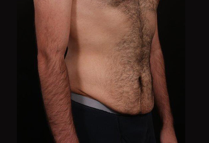 Before Image: Tummy Tuck - right-front-oblique