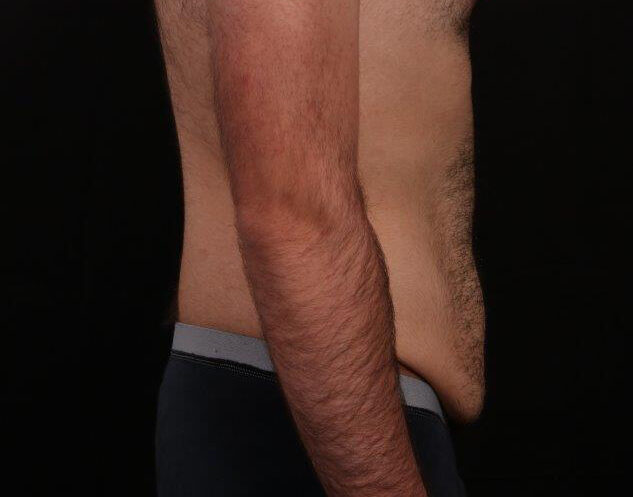 Before Image: Tummy Tuck - right-side