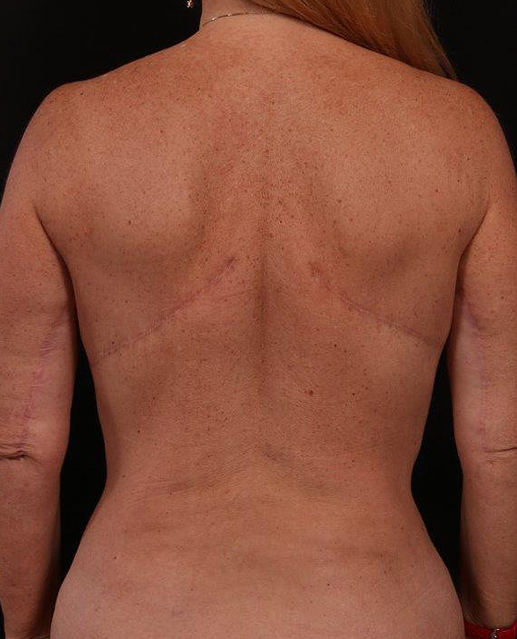After Image: Bra Strap Excision - back