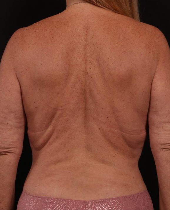 Before Image: Bra Strap Excision - back