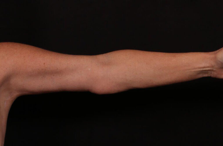 After Image: Brachioplasty - front