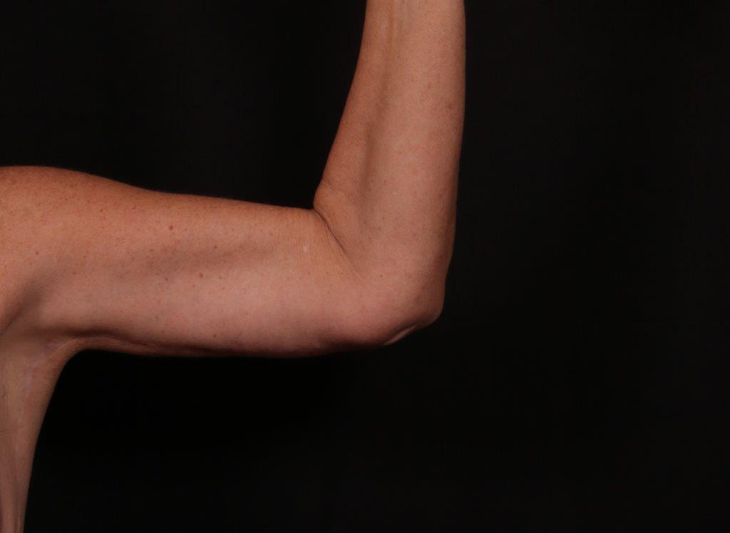 After Image: Brachioplasty - front