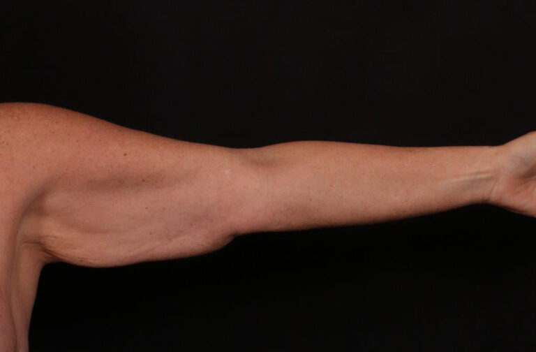 Before Image: Brachioplasty - front
