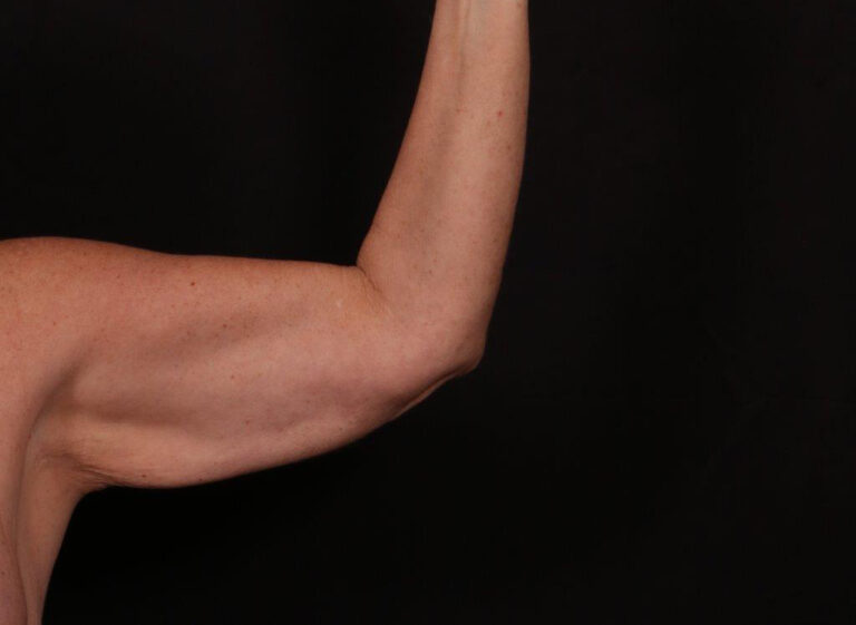 Before Image: Brachioplasty - front