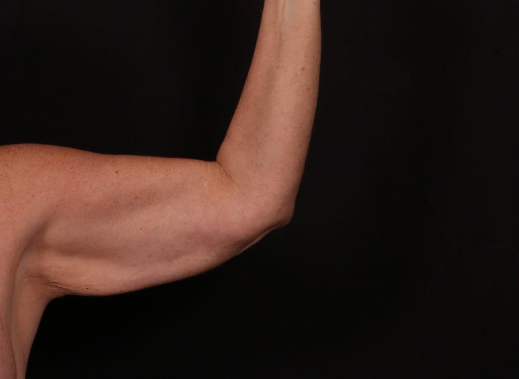 Before Image: Brachioplasty - front