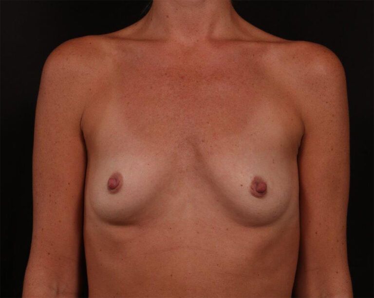 Before Image: Breast Augmentation - front