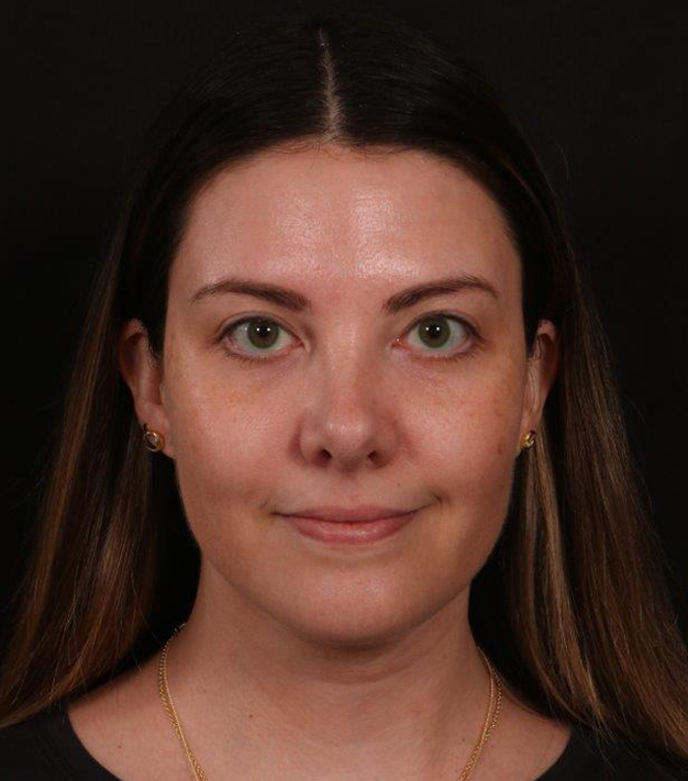 After Image: Neck Liposuction - front