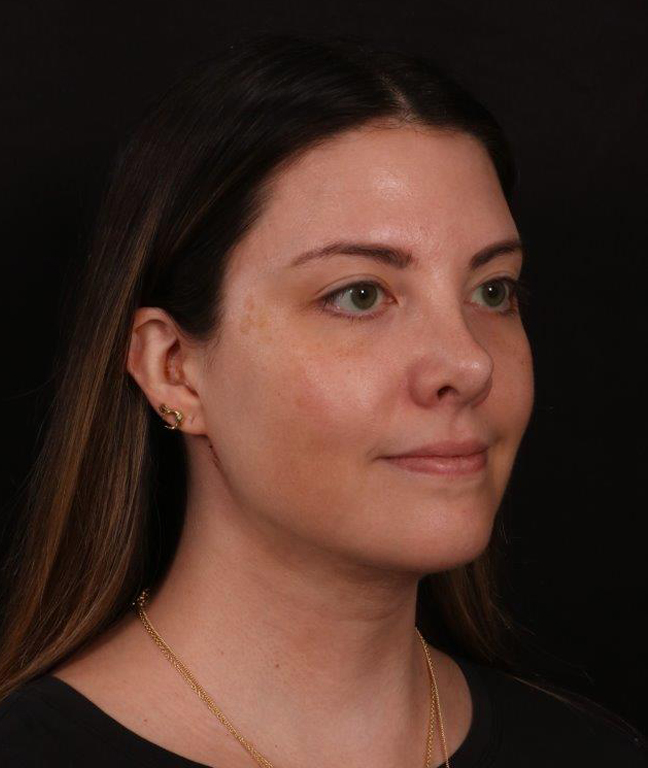 After Image: Neck Liposuction - right-front-oblique