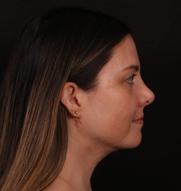 After Image: Neck Liposuction - right-side