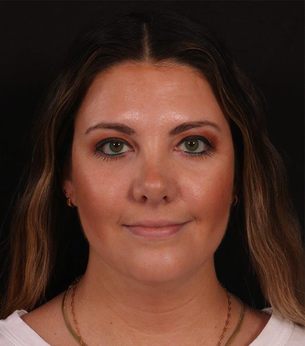 Before Image: Neck Liposuction - front