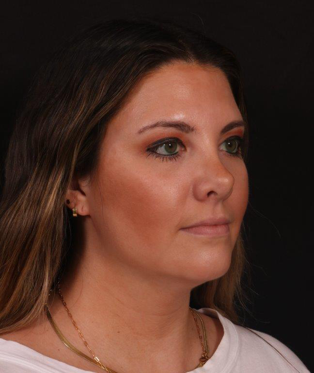 Before Image: Neck Liposuction - right-front-oblique