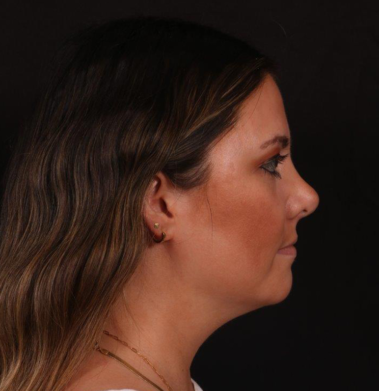 Before Image: Neck Liposuction - right-side