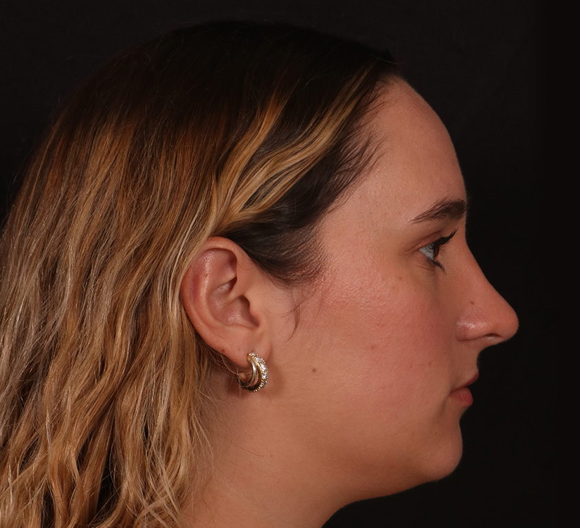 After Image: Rhinoplasty - right-side