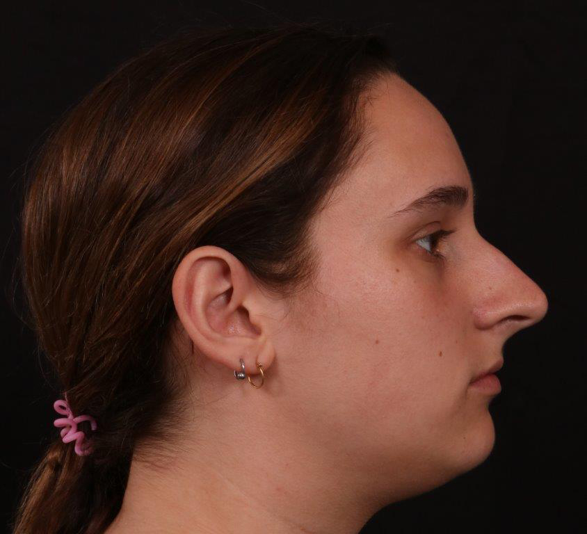 Before Image: Rhinoplasty - right-side