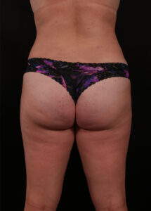 After Image: Liposuction