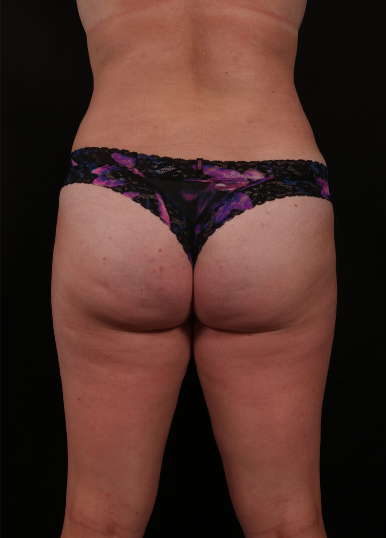 After Image: Liposuction - back