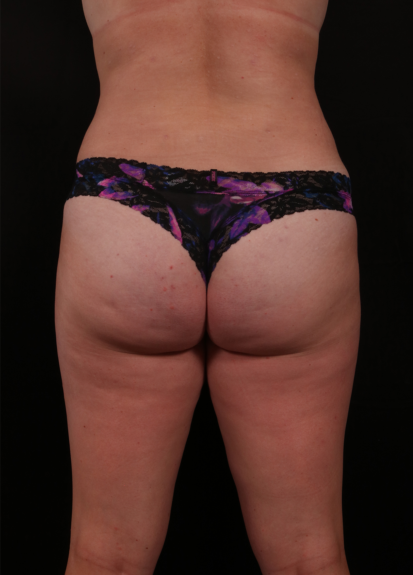 After Image: Liposuction - back