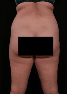 Before Image: Liposuction