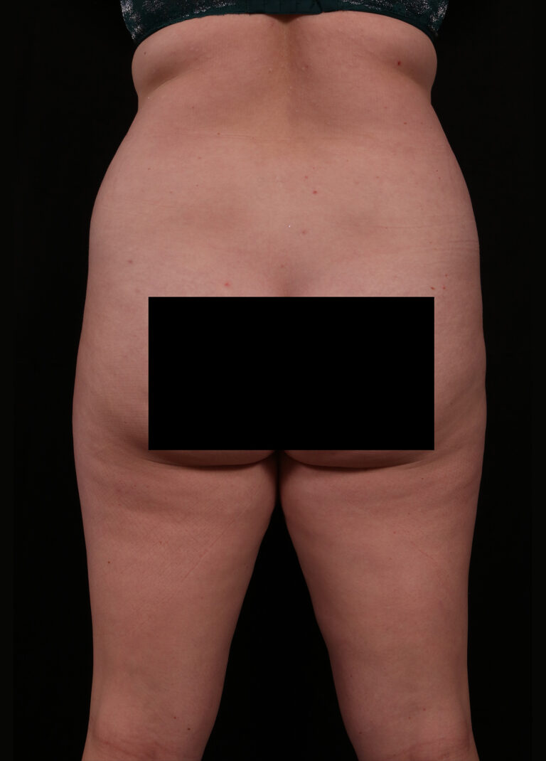 Before Image: Liposuction - back