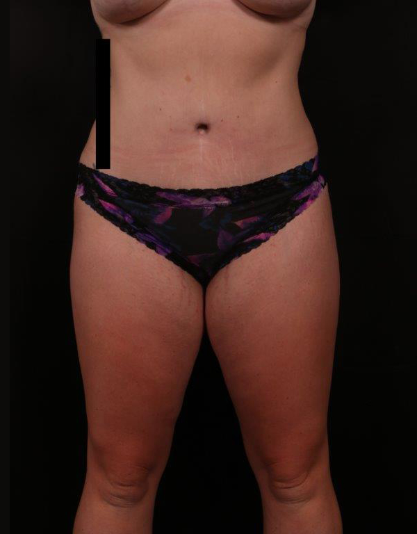 After Image: Tummy Tuck - front