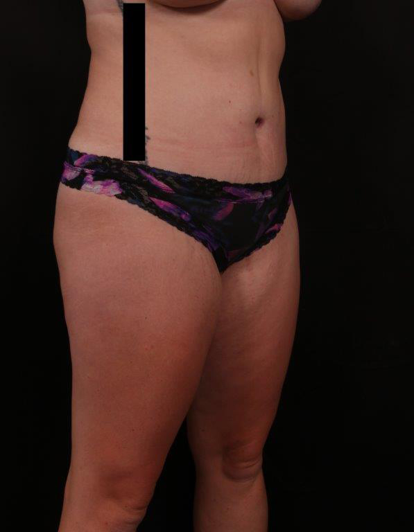 After Image: Tummy Tuck - right-front-oblique