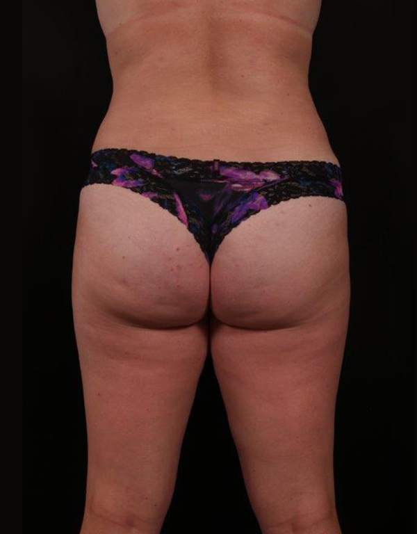 After Image: Tummy Tuck - back