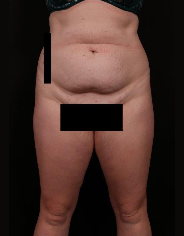 Before Image: Tummy Tuck - front