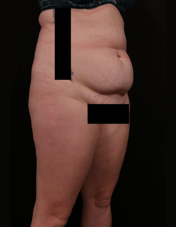 Before Image: Tummy Tuck - right-front-oblique