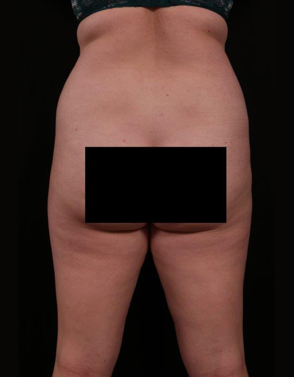 Before Image: Tummy Tuck - back