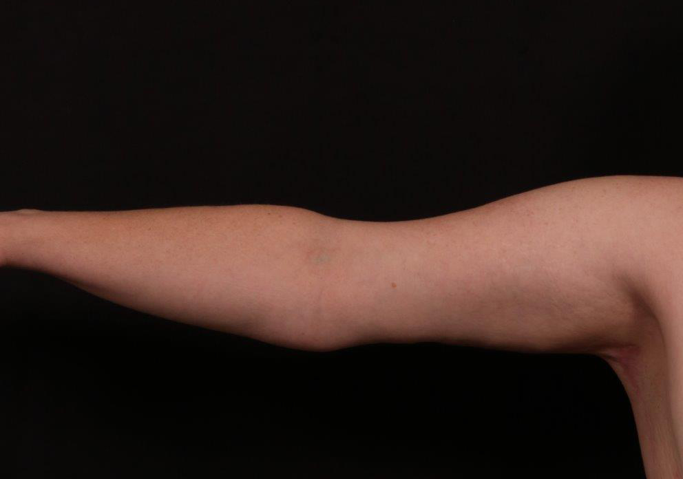 After Image: Brachioplasty - front
