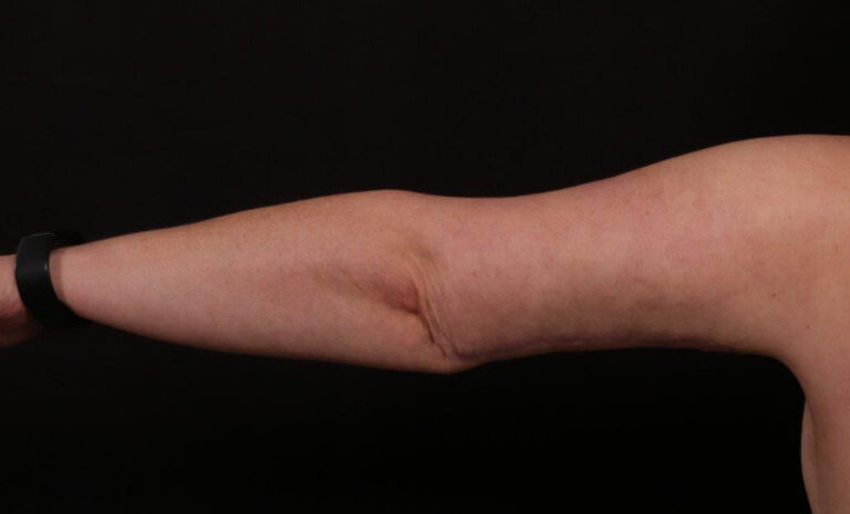 After Image: Brachioplasty - back