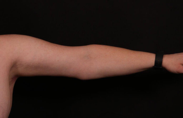 After Image: Brachioplasty - front