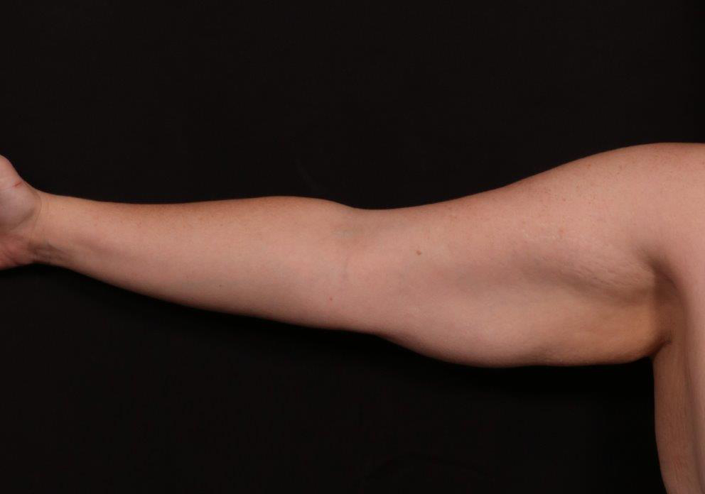 Before Image: Brachioplasty - front