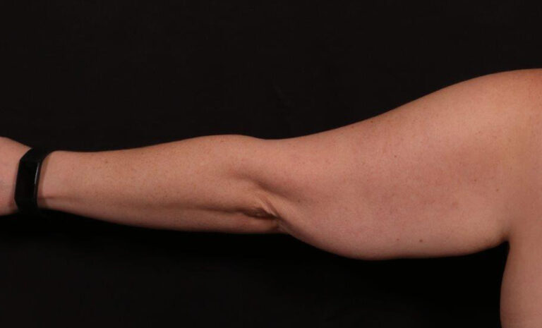 Before Image: Brachioplasty - back