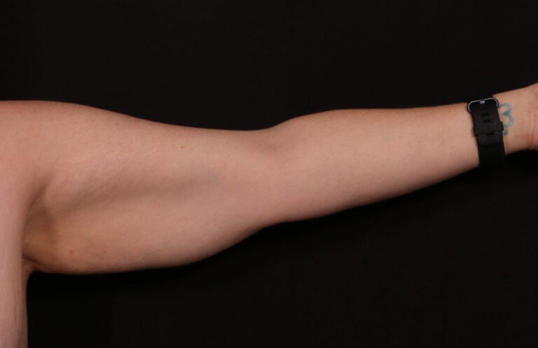 Before Image: Brachioplasty - front