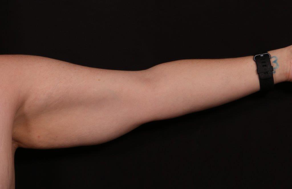 Before Image: Brachioplasty - front