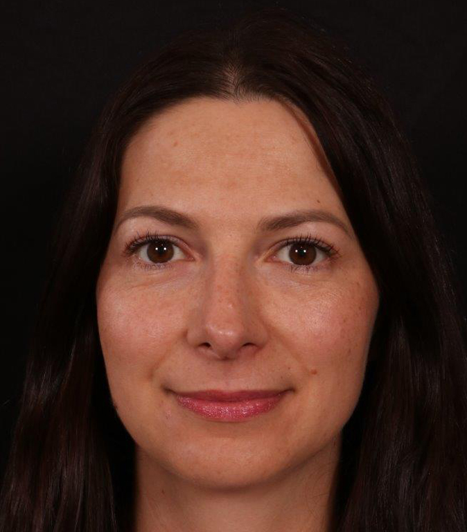 After Image: Rhinoplasty - front