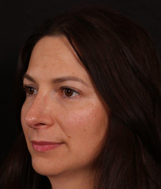 After Image: Rhinoplasty - left-front-oblique