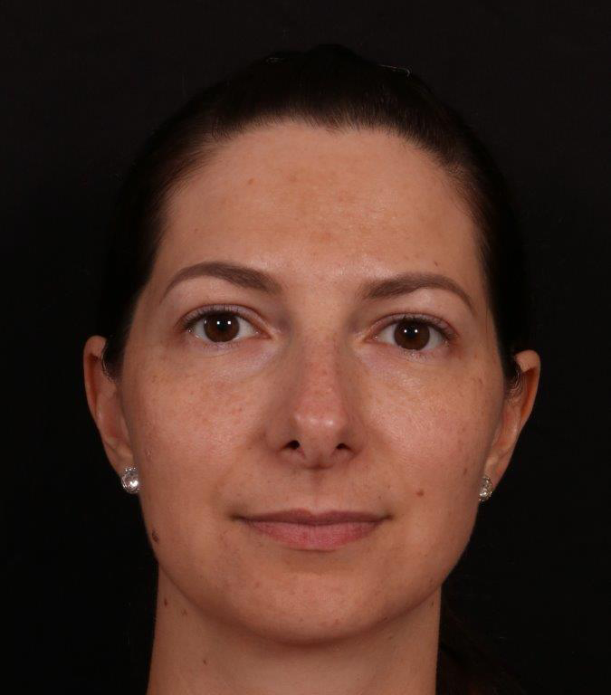 Before Image: Rhinoplasty - front