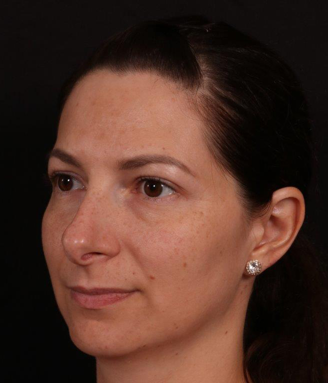 Before Image: Rhinoplasty - left-front-oblique