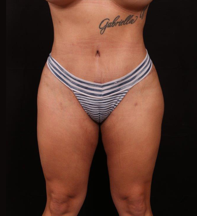 After Image: Tummy Tuck - front