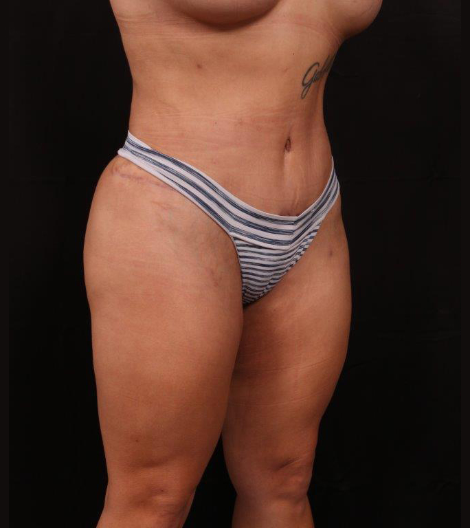 After Image: Tummy Tuck - right-front-oblique