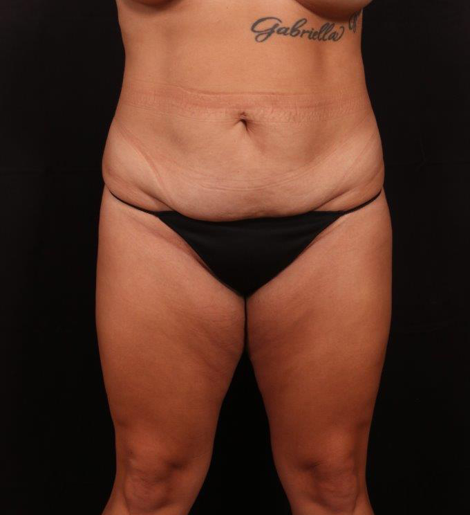 Before Image: Tummy Tuck - front
