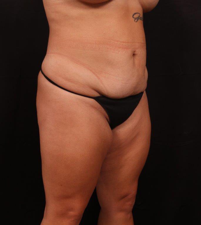 Before Image: Tummy Tuck - right-front-oblique
