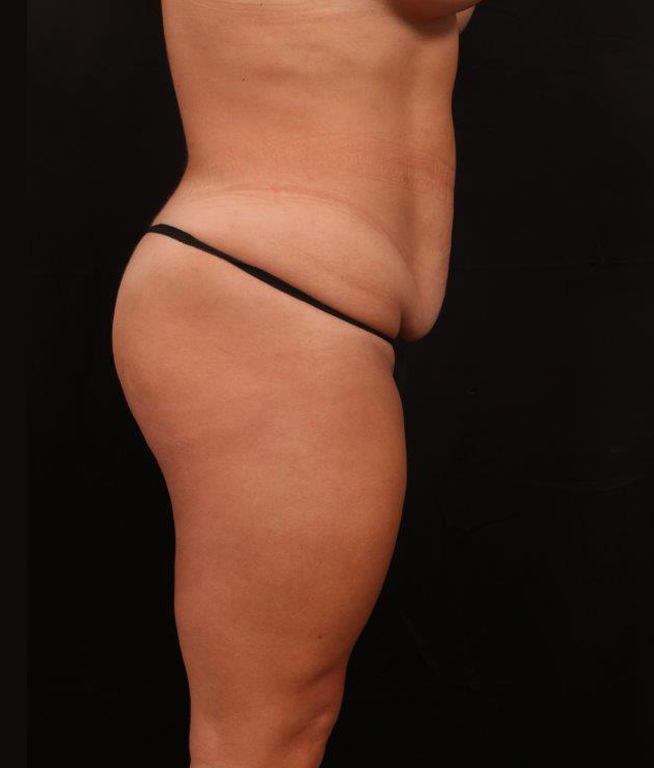 Before Image: Tummy Tuck - right-side