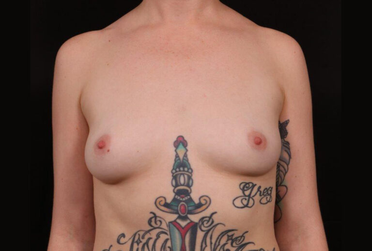 Before Image: Breast Augmentation - front